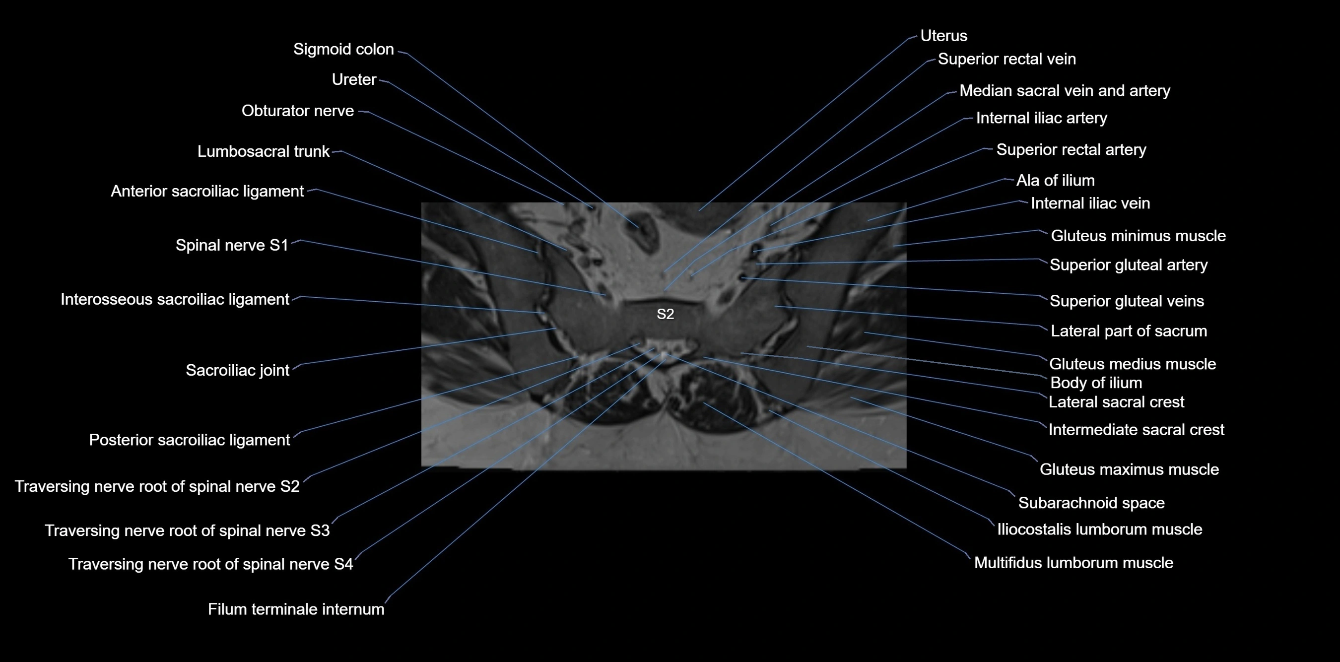 MRI sacrum, coccyx and sacroiliac joint axial cross sectional anatomy 3T  radiology  image-img-00001-00024.webp